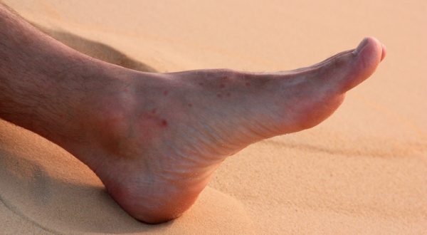 piqûre puce de sable